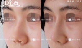 微整形隆鼻最新爆料视频,网红爆料视频大揭秘