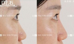 微整形隆鼻最新爆料视频,网红爆料视频大揭秘